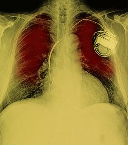 8,000 Vulnerabilities Found in Pacemakers