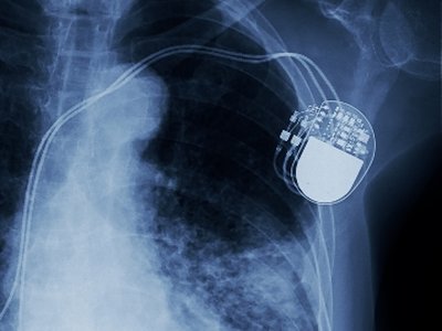 FDA Approves Firmware Fix for St Jude Pacemakers